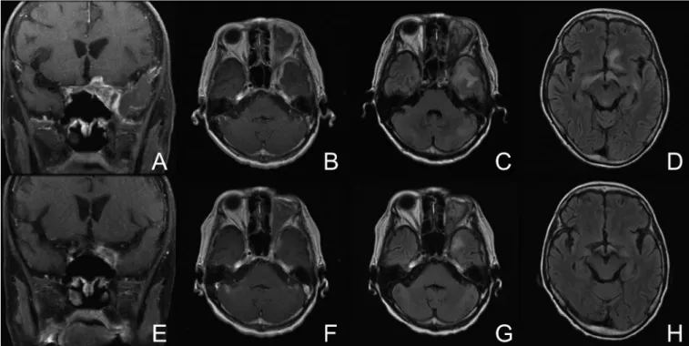 Fig. 1  Postoperative brain MRI before steroid treatment  （A-D）and 1 month after steroid treatment was begun （E-H）.（A, E）Gadolini- E）Gadolini-um-enhanced coronal T1-weighted imaging and（B, F）axial T1-weighted imaging.（C, D, G, H） Axial fluid-attenuated inv