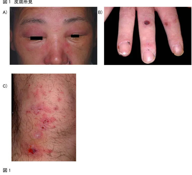 図 1  皮膚所見  A)                                                                              B)  C)                                                                  図 1  A)  自験例にみられた眼瞼部の紫紅色浮腫性紅斑とヘリオトロープ疹  B)  ゴットロン徴候：手指関 節背面の角質増殖や皮膚萎縮を伴う紫紅色紅斑を認める  C)    四肢伸側