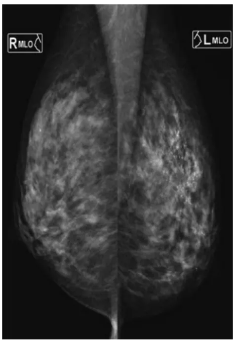 Fig. 1　MMG shows segmental and linear  calcification in the left breast.