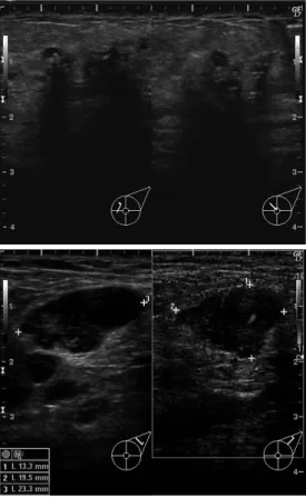 Fig. 3　Enhanced chest CT shows swollen supraclavicular and axillary lymph nodes on the left  side.