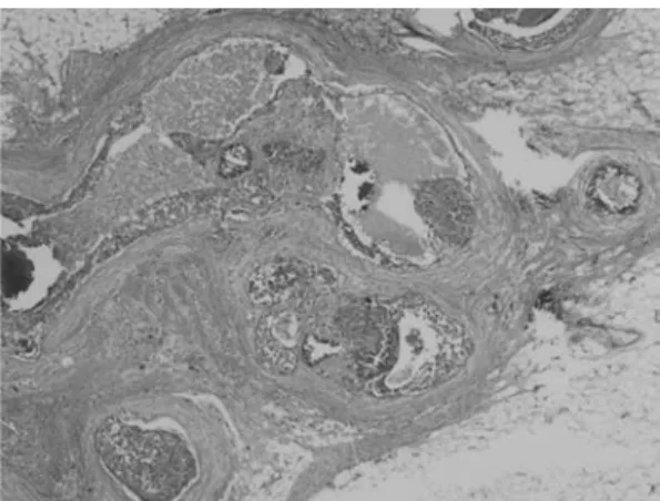 Fig. 5　Sentinel and non-sentinel lymph nodes show multiple non-necrotizing granulomas and  Langerhans’ cells （H.E
