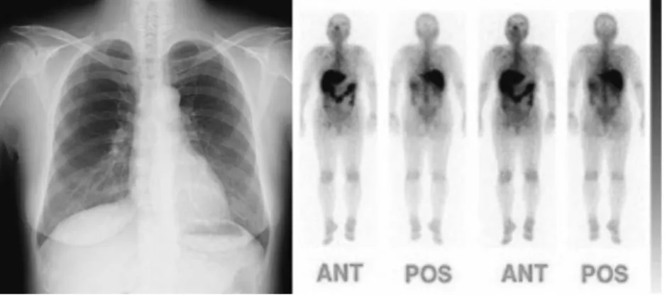 Fig. 7　Chest X-ray does not show enlarged bilateral hilar lymph nodes, and Ga-scin- Ga-scin-tigraphy shows no abnormal accumulations throughout the whole body.