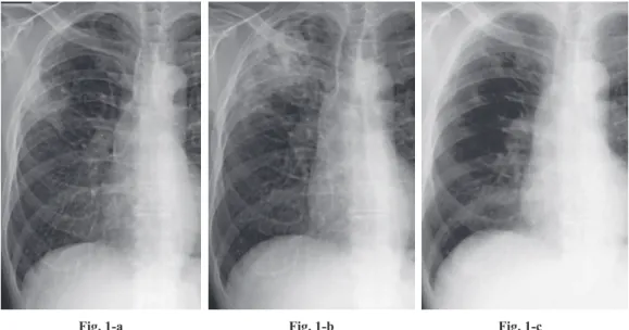 Fig. 1-a：Initial chest radiograph of case 1, showing an inﬁltrate in the right upper and middle lung ﬁelds.