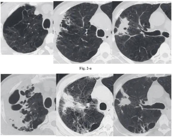Fig. 2-a：Initial chest CT scan of case 1 demonstrating diffuse emphysematous change and a nonsegmental  consolidation in the right S 2 -S 3 