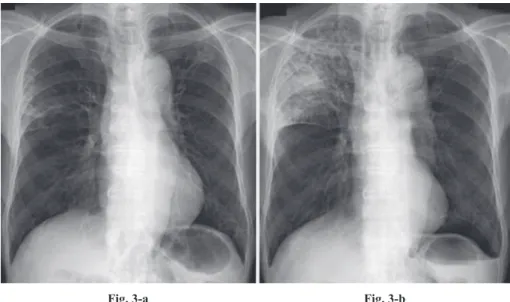 Fig. 3-a Fig. 3-b