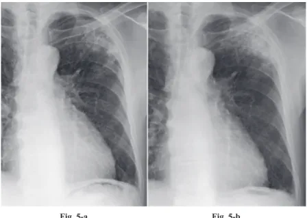 Fig. 6：CT scan demonstrates a nonsegmental consoli- consoli-dation in the left S 1＋2 , with no nodular shadow.