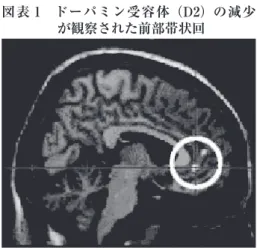 図表 1 ドーパミン受容体（D2）の減少 が観察された前部帯状回 出典：参考文献 2） 䊄䊷䊌䊚䊮ฃኈ૕䈱㊂䈮⋧㑐䈜䉎ᜰᮡ 㪜㪚㪫ᣉⴕ೨ 㪜㪚㪫ᣉⴕᓟ 図表2 ECTの実施前後のドーパミン受容体の量的変化全7症例で減少を確認した 出典：参考文献 2）