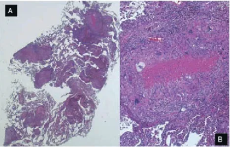 Fig. 4 Histological ﬁndings of necropsy specimen from new lesion in right upper  lobe