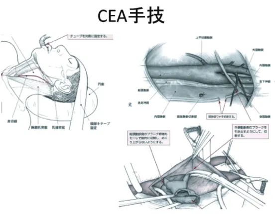 図 8 CEA の術後合併症として過還流症候群に注意が必要 である。