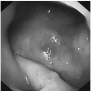 Figure 2. Many non - caseating epithelioid cell granulomas  below epithelium in a biopsy specimen of the  epipharyngeal mass in case one.