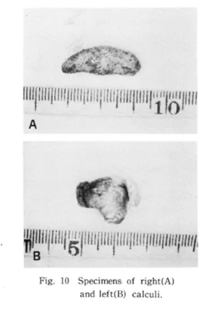 Fig. 10 Specimens of right(A) and left B) calculi. 考     察 唾石症に関する報告は数多くあるが,両側性 顎下腺唾石症は欧米で13例,本邦では本症例も 含め16例と少ない1)2)顎下腺唾石は顎下腺の腺体 内唾石とその排壮管にある腺管内唾石に大きく 分類できる.したがって,両側性顎下腺唾石症 の唾石の位置が,左右とも腺体内あるいは腺管 内にある場合もあれば,一方が腺体内で,他方 が腺管内にある場合もある王)2)3)唾石症に対する 処置をみると,一般的に,腺