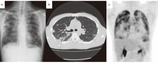 Figure 3.　TBLB（a）とEBUS-TBNA（b）での病理組織学的所見（×100：H. E）．