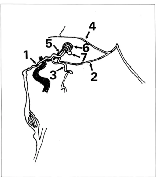 Fig. 4 Schematic drawing of left CAG. 1: insular vein, 2: basal vein, 3: anastomotic me‑