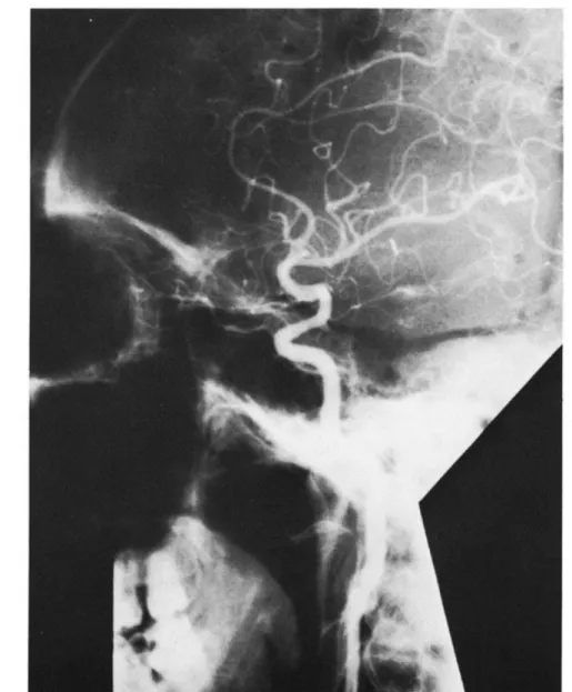 Fig. 6 Left CAG after surgery. AVMand aneurysm could not be demonstrated any more.