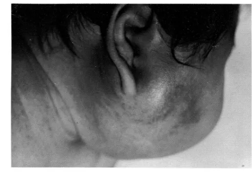 Fig. 2 Fragmented RBC on the peripheral smear