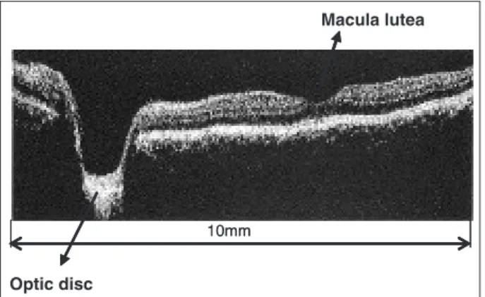 Figure 2 : Example of a retinal tomogram taken by OCT Photograph provided by Microtomography Co., Ltd
