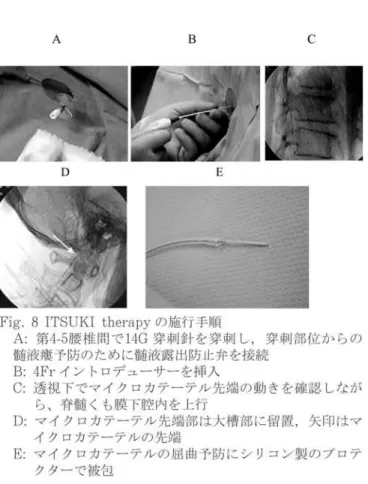 Fig. 8 ITSUKI therapyの施行手順 A:第415腰椎間で14G穿刺針を穿刺し,穿刺部位からの 髄液痩予防のために髄液露出防止弁を接続 B: 4Frイントロデューサーを挿入 C:透視下でマイクロカテーテル先端の動きを確認しなが ら、脊髄くも膜下腔内を上行 D:マイクロカテーテル先端部は大槽部に留置,矢印はマ イクロカテーテルの先端 E:マイクロカテーテルの屈曲予防にシリコン製のプロテ クターで被包 入する.注入後1時間クランプした後,クランプを開 放し血清髄液排出のため脳室ドレナージ回路に接