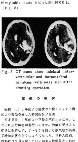Table 6 0perative Results Related to the Findings of CT scan good fair poor Total Ventricular Delatation Mild High Perventncular Lucency Brain Atrophy Subdural Effusion, Hematoma Intracerebral Low Density RI cisternography は8例に施行, 7例に 脳室内逆流現象ventricular re