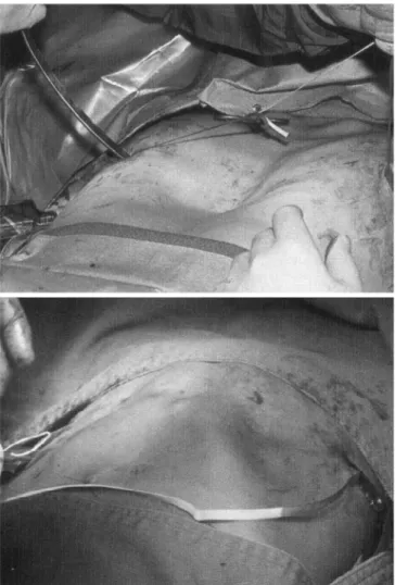 Fig. 1 Incision line and the points that pass through the introducer and pectus bar. あった.術前呼吸機能検査が行われた29例中3例に拘 束性換気障害が見られた.術前の心電図検査では29例 中24例に左房負荷やIRBBBなどの異常所見がみられた が臨床症状を示すものはなかった