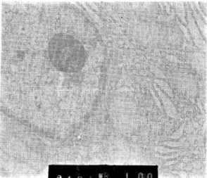 Fig. 6. Electron microscopic fingings of the plasmocytoma 血球数426万, ‑モグロビン13.8g/曲, ‑マトクリ ット42.0%,血小板17.4万,血液像に著変なく,血 沈値は1時間借3mm, 2時間値11mmと貧血および赤 沈菟進は改善し,尿所見では尿蛋白(‑),ベンスジョ ンズ蛋白休日,尿糖(1,尿沈漣正常範囲内.血清学 的にも, CRP凹, RAH, IgA286m9/d且, IgG 1560 n/i且, IgM44m9/d且,補体C313