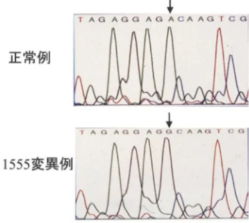 Fig. 1直接シークエンス法によるミトコンドリア遺伝子 1555 A‑>G変異の同定 正常では1555位がA (アデニン)であるが,変異例では G (グアニン)に変化している