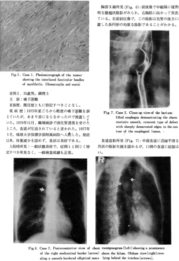 Fig. 5. Case 1. Photomicrograph of the tumor showing the interlaced fascicul ar bundles of myofibrils. (Hematoxylin and eosin) 症例2. 35歳男。調理士 主 訴:嚇下困難 家族歴,既往歴ともに特記すべきことなし。 現病歴: 1972年夏ごろから軽度の噴下困難を訴 えていたが,あまり苦にならなかったので放置して l いた1976年11月,職場検診で消化管透視を受けた ところ,食道が圧