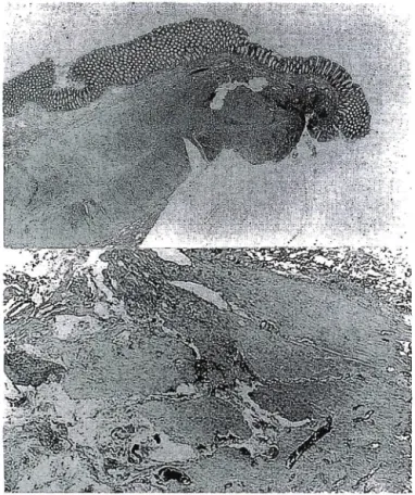 Fig. 3 Microphotographs of the perforated lesion reveal‑ ing a normal‑appearing mucosa and mild inflammation (top right ; HE, ×10), and a tearing of the muscle fibers (top right; HE,×25)