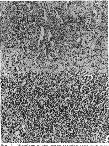 Fig. 3 Histology of the tumor showing nests with glan‑ dular structures of round to oval tumor cells (top; HE x50) and spindle‑shaped cells (bottom; HEX50)