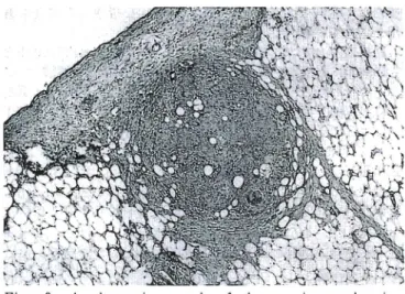 Fig. 3. A photomicrograph of the specimen showing tuberculpsis. 反応しやすい半面,重症化しやすい側面があるためと思われ る.また,透析導入後6-9カ月は特にリンパ網内系の異常 があると言われている1).本症例は免疫力が低下している時期 に2度の腹膜炎に罷患した後,内因性の結核が一気に重症化 したと思われる
