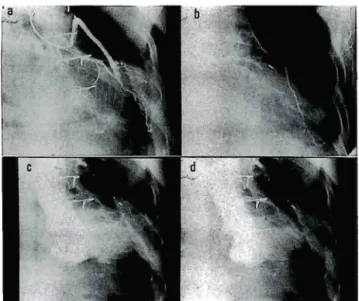 Fig. 3 A postoperative angiogram at 29 days revealing the patent SVG (a) and ITA graft (b). The ejection fraction was increased from 0‑ 35 preoperative (c) to 0‑ 54 postoperative (d), indicating improvement of the left ventricular function