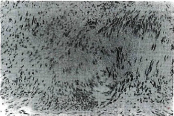 Fig. 2. Histopathology of Case 3. The section taken from the central area shows hypercellular por‑ tions composed of spindle‑shaped cells forming so‑called Verocay bodies, i.e., Antoni type A tissue. Other specimens taken from the peripheral area show hypo