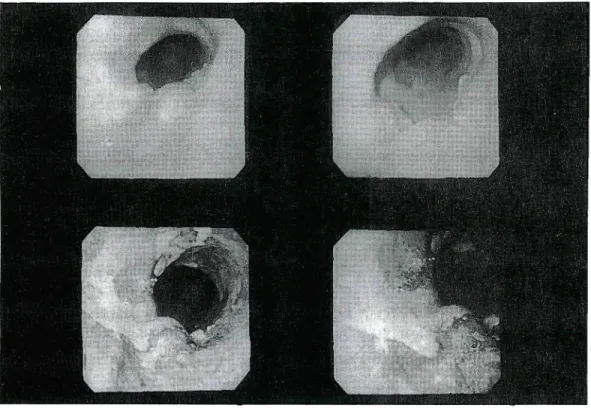 Fig. 2. Endoscopic photograph shows a polypoid lesion with overying smooth mucosa (top) and distal‑irregularly unstained areas (lugol solution spraying method) (bottom).