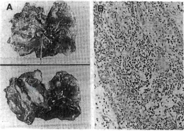 Fig. 4. Operative view Reconstruction of bilateral brachiocephalic veins. 独療法あるいは放射線療法を加えることにより 十分な成果を上げてはいるものの、大血管への 浸潤が高度な皿期例では外科的切除が困難なこ ともあり、予後不良である。しかし手術手技の 向上や長期間存の可能な人工血管の開発により 血管浸潤が高度な胸腺腫に対しても完全切除が 可能となり、また従来では切除不能と考えられ ていた大動脈や肺動脈本幹、主肺動脈へ浸潤が 及んでいる症