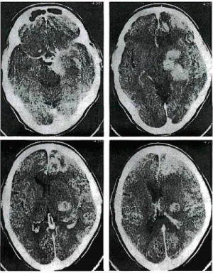 Fig. 1 (case 1 )Superselective 一ingual angbgraph (lateral view). Lt. :Preembolization. The stain of hemangioma is seen