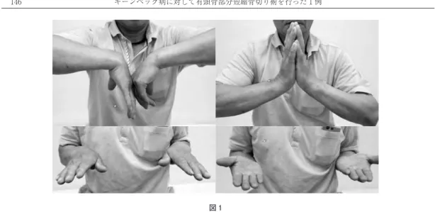 図 1 術前の左手関節の可動域：掌屈 30°/ 背屈 40°，回内 80°/ 回外 90° 図 2　術前の単純レントゲン写真 月状骨は偏平化を認めているが舟状骨の回旋は認めていなかったため Lichtman 分類：Stage Ⅲ A と診断した． T1W1 脂肪脂肪抑制 T2W1 図 3 MRI では T1W1 で月状骨に正常脂肪髄による高信号領域が消失し，脂肪抑制 T2W1 では一部高信号域を呈していた．キーンベック病に対して有頭骨部分短縮骨切り術を行った１例 ― 146 ―146