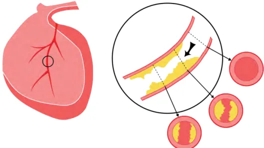 Fig. 1.1 Illustration depicting the human heart and the plaques of CAD in the blood vessel.