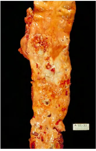 Fig. 1.3 A specimen of the vessel with atherosclerosis tissues from one patient.