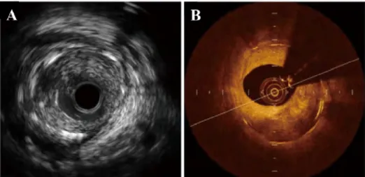 Fig. 1.7 A cross-section of an artery captured with two modalities: IVUS and IVOCT. (B) presents more useful lesion tissue information to represent the detailed inner structure of the vessel than (A).