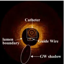 Fig. 1.8 The main components of an IVOCT image are comprised of a catheter (white big rectangle), a Guide-wire (white small rectangle), a GW sector shadow (white ellipse) and the vessel lumen with a black background.