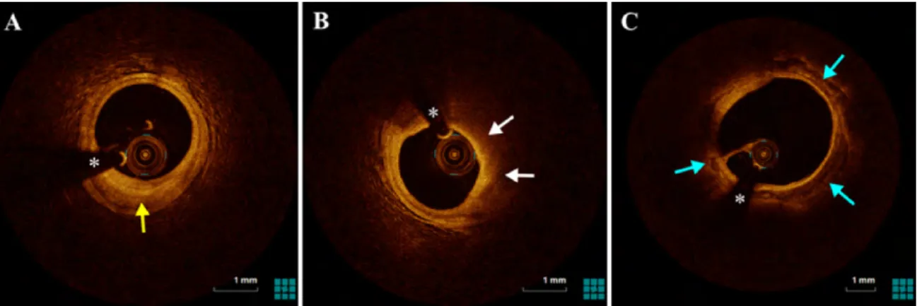 Fig. 1.9 Three IVOCT image examples of the atherosclerosis plaque corresponding to the 3 types, (A) fibrous plaque (yellow arrow), (B) lipid plaque (white arrow), (C) calcified plaque (blue arrow), respectively
