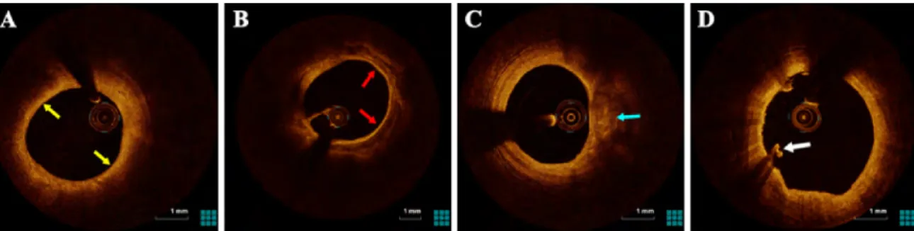 Fig. 1.11 Examples of other types of plaque components with different lesion morphology.