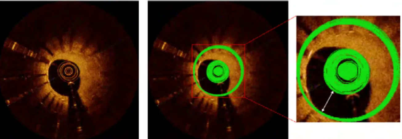 Fig. 2.9 Illustration of catheter imaging region detection. Superfluous detection circles were also generated simultaneously with the correct results if the value of λ larger than 0.375.