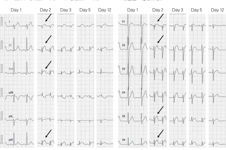 Fig. 1 Serial change in 12-lead electrocardiogram in case 1
