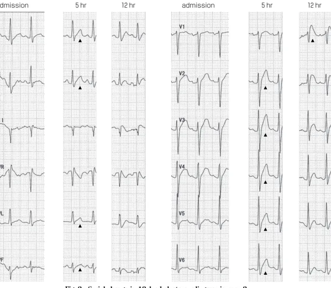 Fig. 2 Serial change in 12-lead electrocardiogram in case 2