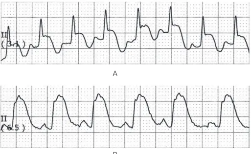 Fig. 3 ECG monitoring of case 2 was done 15 hours （A） and 16 hours （B） after admission  ST-segment elevation progressed rapidly, the patient suffered circulatory collapse, and consequently  had a cardiac arrest