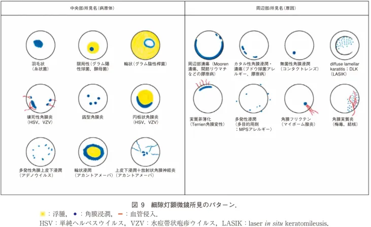 図 9 細隙灯顕微鏡所見のパターン．