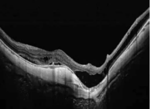 図 4   病的近視眼の swept ― source OCT 画像（ 2 ） 強膜のカーブが高度に変形し，それに伴い網膜分離 がみられる． a．下からみた画像 b．鼻側からみた画像 図 5   病的近視眼の 3D MRI画像 下からみた画像（a）および鼻側からみた画像（b）において眼球が高度に 変形し，正常の球形から逸脱している．