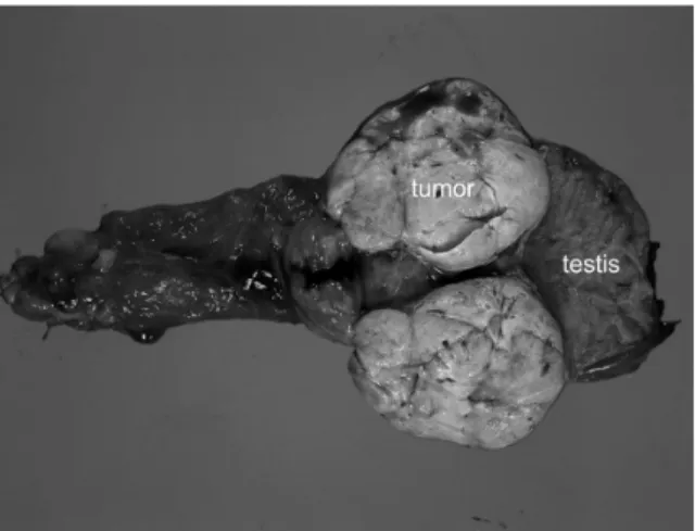 Fig. 4. Gross appearance of the right testis. The tumor was yellow-white and well deﬁned.