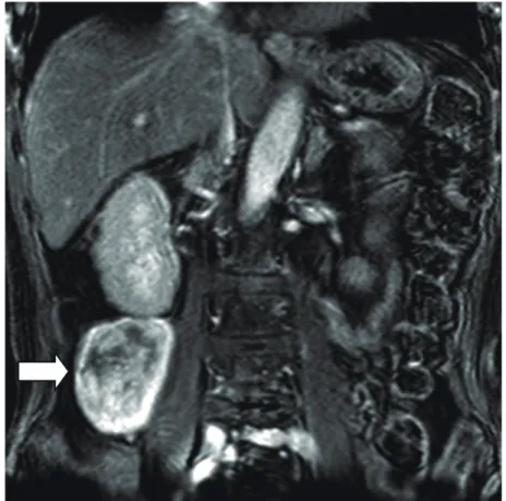 図 1 A  入院時腹部造影 MRI ( 冠状断 )