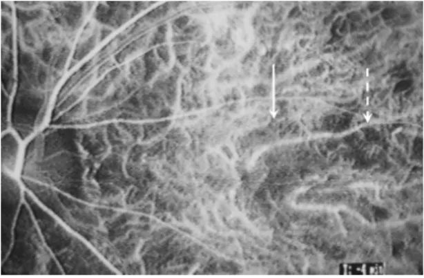 図 23　網膜下線維増殖を伴う多発性脈絡膜炎  星状の網膜下増殖組織と多発性の黄白色斑状病巣が，網膜 色素上皮から脈絡膜レベルに散在していた ７. 考察 　白点症候群は，黄斑部の急性炎症性疾患で，範 囲は眼底の後極部から赤道部までに及び，網膜深 層（網膜色素上皮から脈絡膜内層レベル）に多数 の黄白色滲出斑が急性散在性に生じる。いずれも 病因は不明であり，病理組織学的検索も行われて いない。 　滲出斑の大小，濃淡，後に瘢痕や線維性増殖な どの随伴症状を伴うか否かにより，臨床像にもと づいて様々な病名で呼ばれて